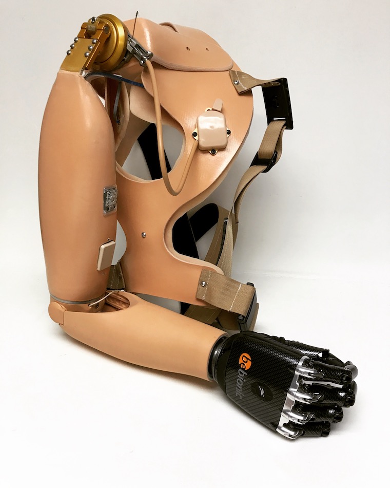 shoulder-disarticulation-prosthesis-fabrication-motion-unlimited